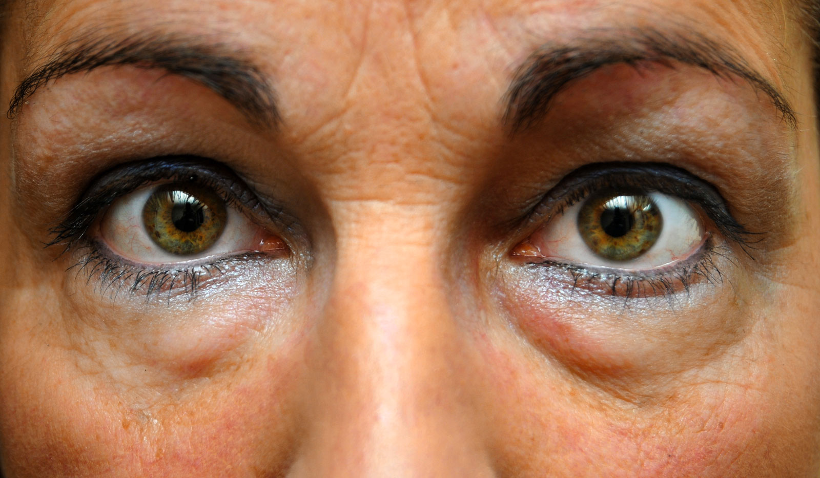 Cum se tratează ganglionii varicoși, Cum să eliminați ochii varicoși sub ochi